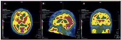 Punding Behavior as a Red Flag for Dementia in a Patient With Depression: Case Report